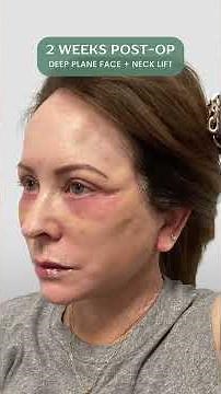 Deep Face & Neck Lift Recovery: Part 2 | Patient Healing Journey