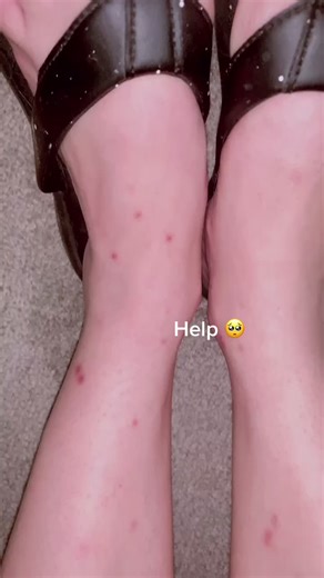 How to Identify Ant Bites vs Flea Bites and Get Rid of Them