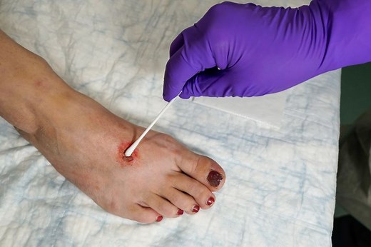 How to Collect an Mpox Specimen for Diagnostic Testing