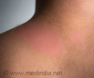 Sunburn Prevention: Tips to Protect Your Skin