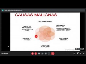 9. Bocio Nodular, Bocio multinodular, nodulo tiroideo