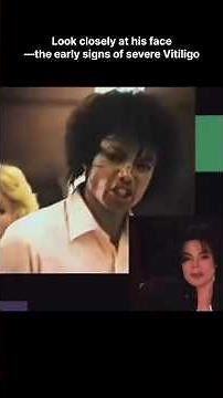 Rare Michael Jackson Vitiligo Clip | Showing His True Condition