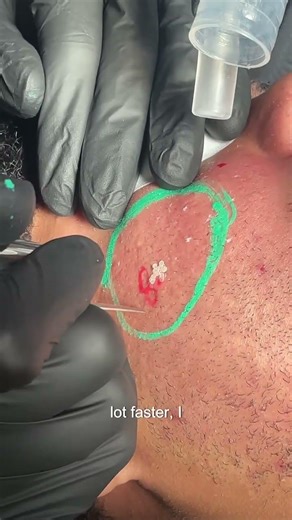 Treating Acne Scars on Melanated Skin at QCC