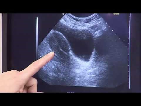 Why use the Wallace Sure-Pro Ultra embryo transfer catheter?