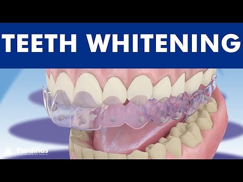 Teeth whitening - How is it done? ©