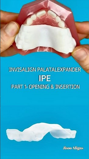 Invisalign Palatal Expander IPE Part 1 #Invisalign #IPE #InvisalignIPE #PalatalExpander