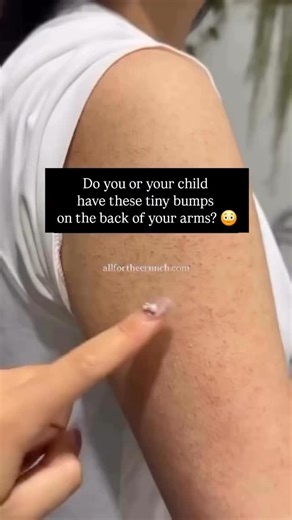 Ricky on Instagram: "PARASITES & SKIN CONDITIONS: VERY LINKED ⚠️ I have seen countless people completely clear their chronic skin issues after a parasite cleanse. It is NOT uncommon. Parasites compromise the liver, and if the liver is not functioning optimally it will offset its toxic load through the skin which manifests as various skin disorders. My daughter-in-law CLEARED her acne after having suffered with it for over 15 years after passing liver flukes during a parasite cleanse. It has NOT 