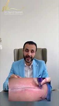 Suturing of plastic surgery incisions and sealing with Dermabond mesh glue