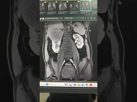 MRI Urography (MRU) MRI Technique and Findings 