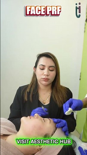 Face PRF Treatment Procedure