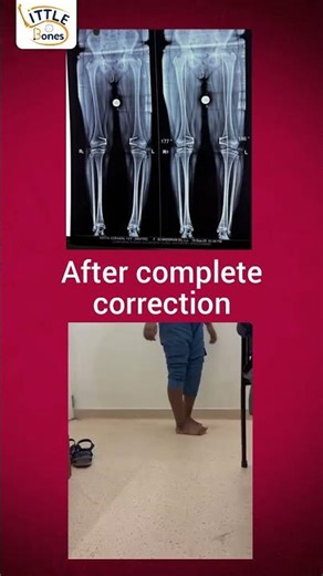 Knock Knees Corrected with Growth Modulation Surgery | Successful Case| Dr. Pushpvardhan Mandlecha