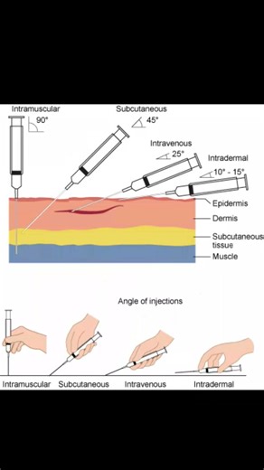 Injection Techniques and Angle of injection 💉