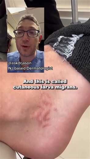 Understanding Cutaneous Larva Migrans: Skin Rash Worm Infection Explained