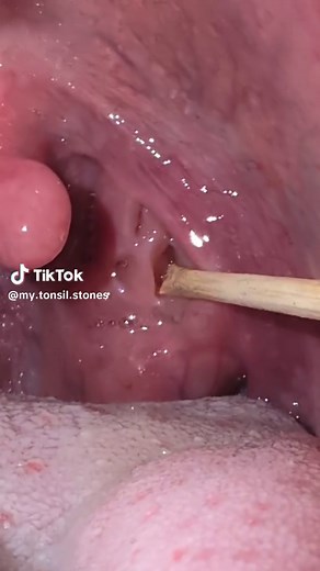 #asmr #tonsiliths #tonsilstones #mouth