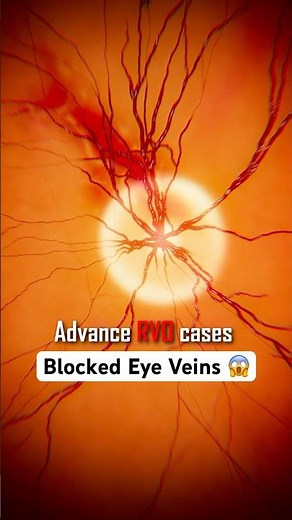 Treatment of Blocked Eye Veins (RVO ) #facts #trendingsongs #eyecare #eyedoctor