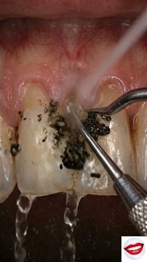 Black Triangle Between Teeth – Deep Dirt Removed Satisfyingly