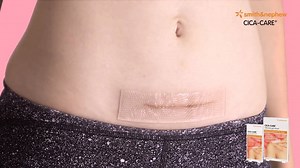 Looking to improve the appearance of post-surgery scars? CICA-CARE is a self-adhesive silicone gel sheet which covers the red, raised scar and produces a moisturizing effect which helps to flatten the scar, improve the texture and help to take away the colour. CICA-CARE is durable, comfortable and re-usable, ideal for day and night use. Safe to use on children and adults, and can even be used on scars up to 20 years old! Try yours today at your nearest #GuardianSG stores or online. | Guardian He