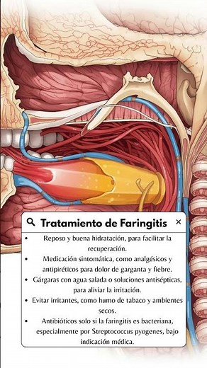 ¿Como tratar la Faringitis? #faringitis #dolordegarganta #medicina #salud