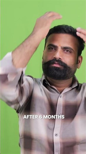 Best Hair Transplant In Noida | IFT Hair Science