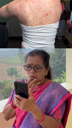 உடம்பு முழுக்க பருக்கள் வருதா? Get Rid of Body Acne | Back Acne #shorts #acnetreatment