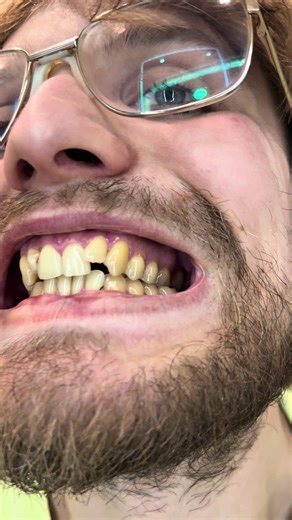 Хейт от комментаторов(любимая рубрика) | #WW210853 (копируй с WW) | #плохиекомментарии #токсичность Жёлтая эмаль на зубах часто воспринимается как недостаток, особенно в эпоху культа белоснежной улыбки. Однако на самом деле естественный желтоватый оттенок эмали — это скорее плюс, чем минус, и вот почему. 1. Признак крепкой эмали Жёлтый оттенок обычно говорит о том, что эмаль достаточно толстая и плотная. Именно под ней находится дентин — ткань, которая от природы имеет жёлтый цвет. Чем толще и з