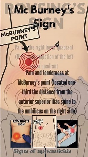 Appendicitis signs in physical examination| Mc burney's sign | Rovsing's Sign | Psoas sign #nclex