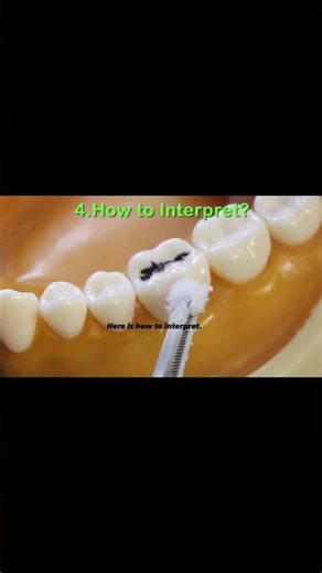 cold test, endodontics pulp vitality test