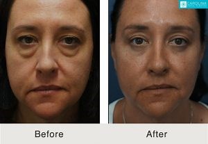 Facial Fat Transfer Charlotte, NC | Carolina Facial Plastics