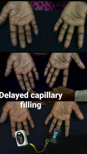 Demonstration of delayed capillary refilling
