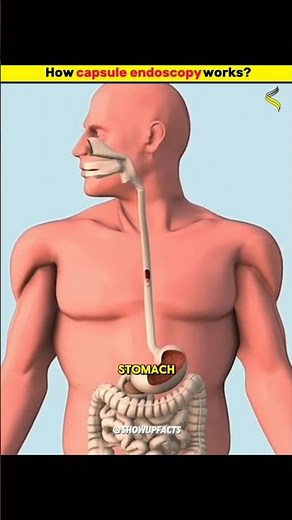 How capsule endoscopy works 💊