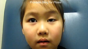 Frontalis Sling for Congenital Ptosis