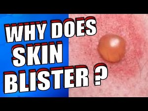 Why Does Skin Blister | How To Treat & Prevent Skin Blisters Naturally