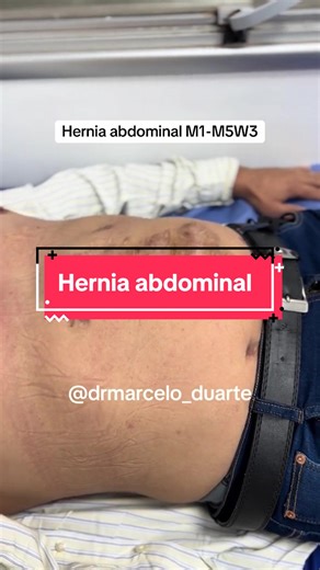 Antes y Después: Cirugía de Hernia Abdominal Compleja
