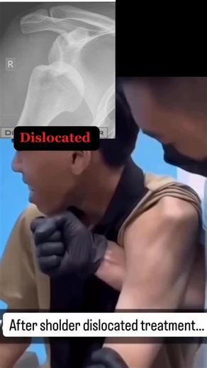 Zikky Kanu, M.D. on Instagram: "Dislocated shoulder treatment. This should only be done by trained medical professionals. Disclaimer: This content is for medical education purposes only and is not intended to substitute for professional medical advice, diagnosis, or care."