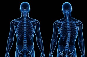 Skoliose: Wie eine Stuttgarterin mit ihrer schiefen Wirbelsäule lebt