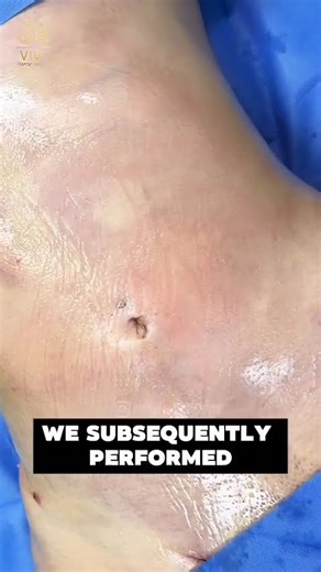 360° Body Sculpting 🔥 Ultrasonic Lipo Results at Vive Plastic Surgery #tijuana 🤩