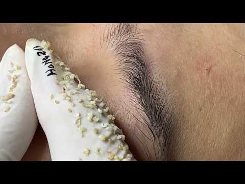 Relax & Unwind: Gentle Acne Treatment (ASMR) #03 | Loan Spa
