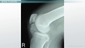 Major Pathologies of Bone