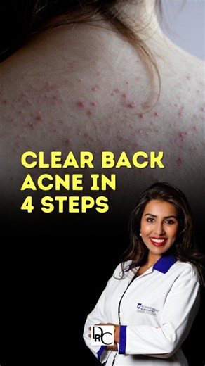 Dr Chytra | Dermatologist | Health | Wellness | on Instagram: "Struggling with stubborn back acne that just won’t go away — especially in this heat? You might be doing a few everyday things that unknowingly trigger those breakouts. Watch this reel to learn 4 simple dermatologist-approved tweaks that can make a huge difference. ✨ Hit save if you’ve been dealing with body acne lately! ......... Disclaimer: For educational and public awareness only. Do consult with a physician in your area for medi