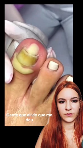 Como tratar unhas encravadas com pus