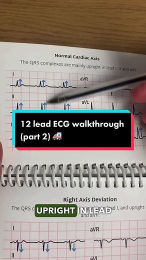12 Lead ECG Walkthrough: Understanding PR Intervals, Q Waves, and ST Segments