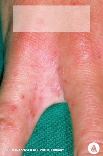 With classic scabies, erythematous papules initially appear in finger web spaces, flexor surfaces of the wrist and elbow, axillary folds, along the belt line, or on the lower buttocks. Refresh your knowledge: https://mrkmnls.co/4o4OzFi | Merck Manual Professional