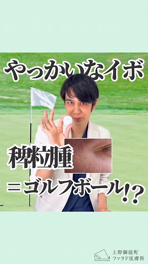 目の周りにできる白いイボ、稗粒腫（はいりゅうしゅ／ひりゅうしゅ）について解説💡 目のまわりや頬にポツポツとできる白い粒、 それは「稗粒腫」と呼ばれる角質のかたまりです。 自分で押したり針で取ろうとしても、 なかなか取れなかったり、傷や色素沈着の原因になることも⚠️ 稗粒腫は皮膚科で除去できます。 保険適用で、10個未満の場合は自己負担3割で約220円。 治療は、細い針で小さな穴をあけて 医療用ピンセットや圧出器で取り出します。 目のまわりでも処置可能です✨ 白いイボや稗粒腫が気になる方は、是非、ご相談ください✨ ーーーーーーーーーーーーーーーー 皮膚科専門医・美容外科専門医による 皮膚科・美容皮膚科の役立つ情報発信中 @dr.kamijo ーーーーーーーーーーーーーーーー 上野御徒町ファラド皮膚科 東京都台東区上野3-27-1 十仁タワー 7階 皮膚科・美容皮膚科・形成外科・アレルギー科 御徒町駅南口すぐ、上野広小路駅・上野御徒町駅・仲御徒町駅徒歩1分、湯島駅徒歩6分 https://falado-derm.com TEL：03−5846−8091 診療時間(診察受付時間) 月火水金