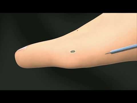 Minimally Invasive Bunion Surgery Animation