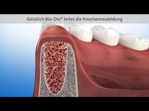 Mit Ridge Preservation bleibt die Knochenkontur erhalten.