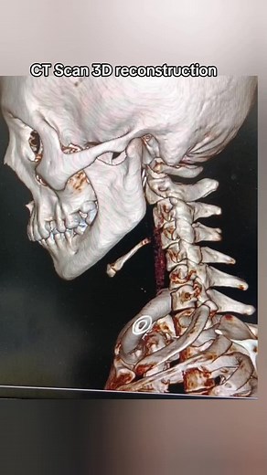 CT Scan 3D Reconstruction of Facial Bones