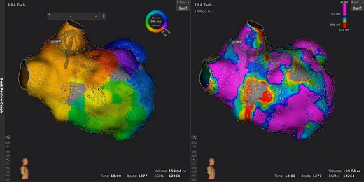 13K views · 58 reactions | #JACCCEP Editors' Insights: Atrial tachycardia is characterized using high density mapping with the Rhythmia system. Learn how detailed mapping helps identify of arrhythmia mechanisms in this multicenter experience. https://bit.ly/2Z2O5FL | JACC Journals | Facebook