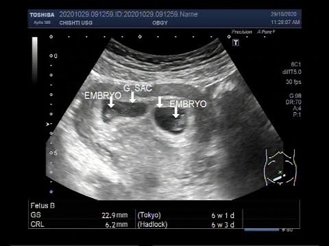 Ultrasound Video showing Early first trimester ( 6 weeks 01 day ) twin Pregnancy.