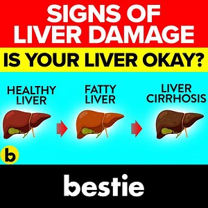 54K views · 646 reactions | Here are warning signs that your liver is suffering and how to prevent damage. According to the John Hopkins Medicine Health Library, cirrhosis and other chronic liver diseases are common causes of death in the U.S. It also states that, on average, 31,000 people in the U.S. die each year from cirrhosis. So it’s imperative for people to look for signs of liver damage. | Bestie | Facebook