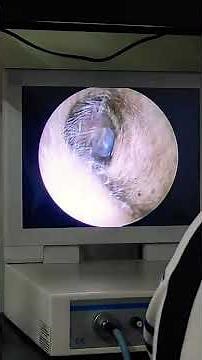 Tympanic Membrane of Ear